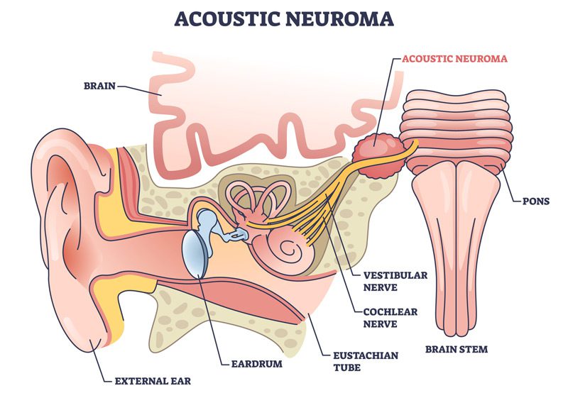 Acoustic-neuroma-diagram Acoustic-neuroma-diagram