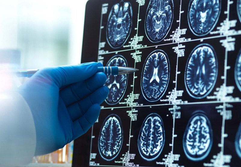 Doctor-pointing-at-brain-MRI-scan