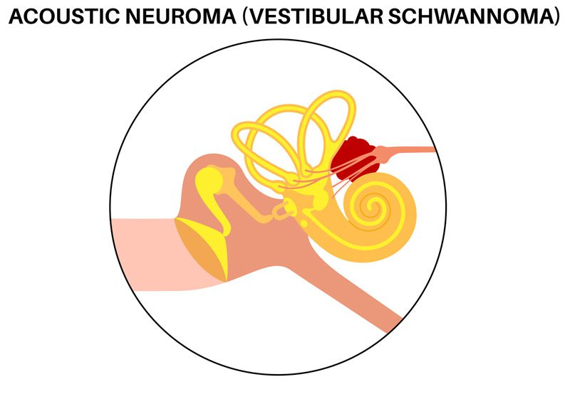 Vector-illustration-of-acoustic-neuroma Vector-illustration-of-acoustic-neuroma